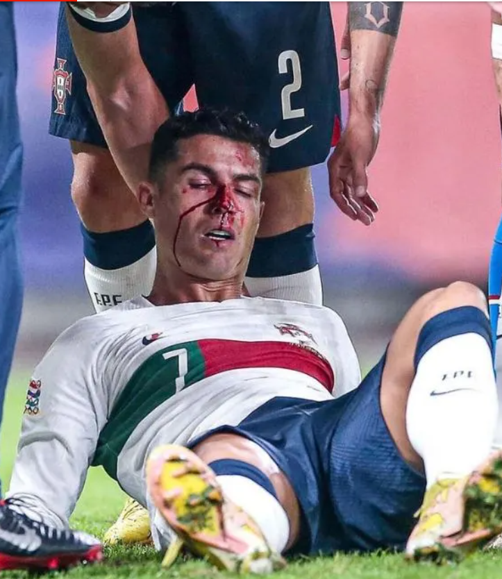 Ronaldo របួសអំឡុងពេលការប្រកួត Nations League ជាមួយសាធារណរដ្ឋឆេក